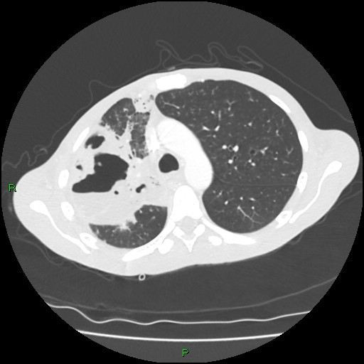 File:Acute right lung abscess (Radiopaedia 34806-36258 Axial lung window 60).jpg