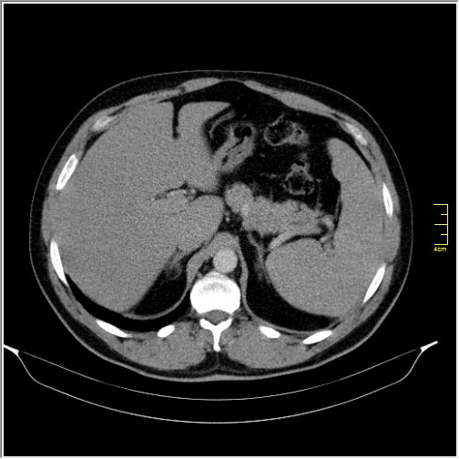 File:Acute right sided diverticulitis (Radiopaedia 65249-74268 Axial C+ portal venous phase 17).JPG