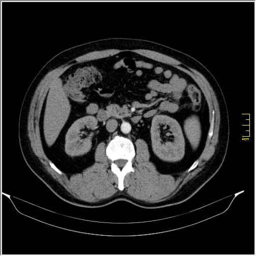Acute right sided diverticulitis (Radiopaedia 65249-74268 Axial C+ portal venous phase 32).JPG