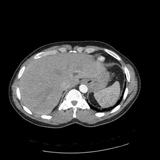 File:Acute segmental pulmonary emboli and pulmonary infarction (Radiopaedia 62264-70444 Axial C+ CTPA 101).jpg