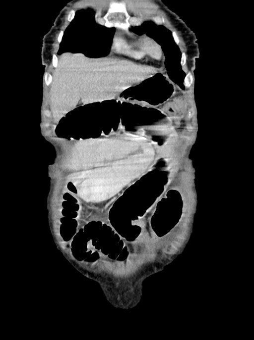 Acute small bowel (ileal) volvulus (Radiopaedia 71740-82139 Coronal C+ portal venous phase 20).jpg