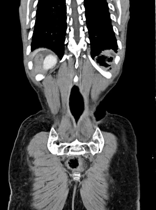 Acute small bowel (ileal) volvulus (Radiopaedia 71740-82139 Coronal C+ portal venous phase 99).jpg