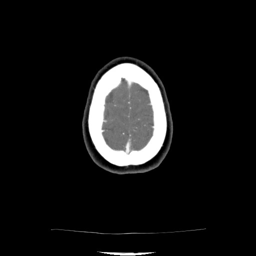 Acute subarachnoid hemorrhage and accessory anterior cerebral artery (Radiopaedia 69231-79009 Axial C+ arterial phase 121).jpg