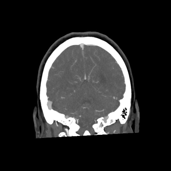 Acute subarachnoid hemorrhage and accessory anterior cerebral artery (Radiopaedia 69231-79009 Coronal C+ arterial phase 60).jpg