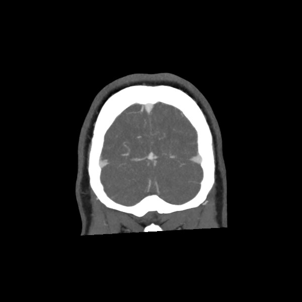 Acute subarachnoid hemorrhage and accessory anterior cerebral artery (Radiopaedia 69231-79009 Coronal C+ arterial phase 73).jpg