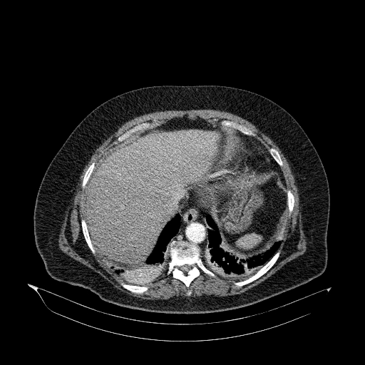 File:Acute superior mesenteric artery occlusion (Radiopaedia 51288-56960 Axial C+ arterial phase 7).jpg