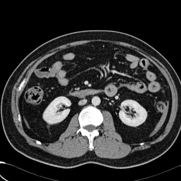 File:Acute traumatic mesenteric bleed (Radiopaedia 37561-39428 Axial C+ portal venous phase 76).jpg