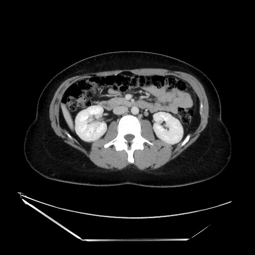 Acute uncomplicated appendicitis (Radiopaedia 73704-84499 Axial C+ portal venous phase 66).jpg
