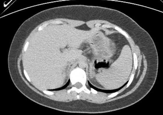 Acute unilateral nonhemorrhagic adrenal infarction (Radiopaedia 67560-76957 Axial renal excretory phase 16).jpg