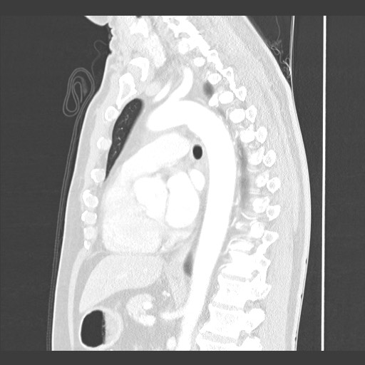Adenocarcinoma of the lung (Radiopaedia 59871-67325 Sagittal lung window 57).jpg