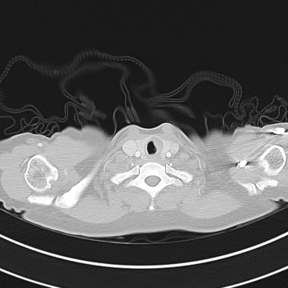 Adenocystic carcinoma of the trachea (Radiopaedia 47677-52525 Axial lung window 27).jpg
