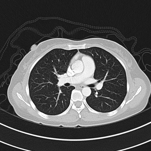 Adenocystic carcinoma of the trachea (Radiopaedia 47677-52525 Axial lung window 51).jpg