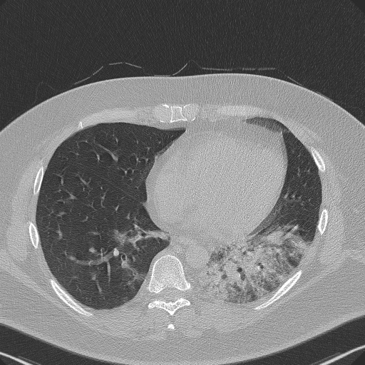 Adenoid cystic carcinoma of the trachea (Radiopaedia 49042-54137 Axial lung window 234).jpg