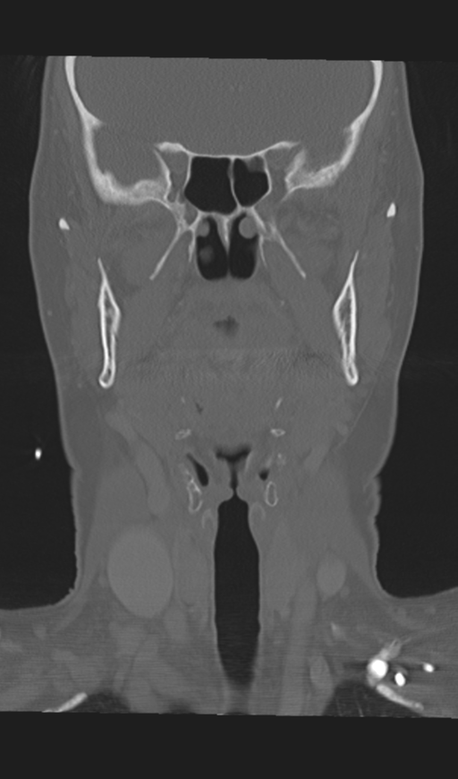 Adenoid cystic tumor of palate (Radiopaedia 46980-51518 Coronal bone window 30).png