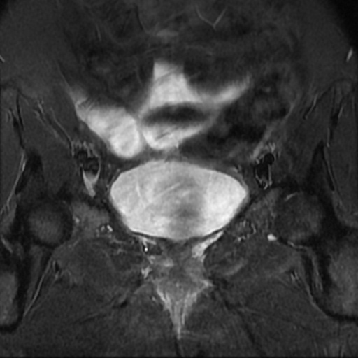File:Adenoma malignum of cervix (Radiopaedia 66441-75705 Coronal STIR 1).jpg