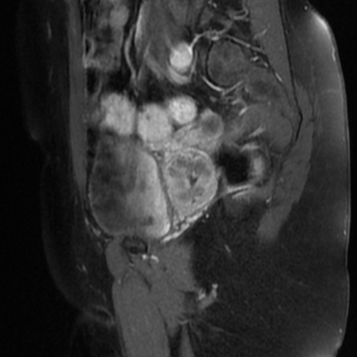 File:Adenoma malignum of cervix (Radiopaedia 66441-75705 Sagittal T1 C+ fat sat 17).jpg