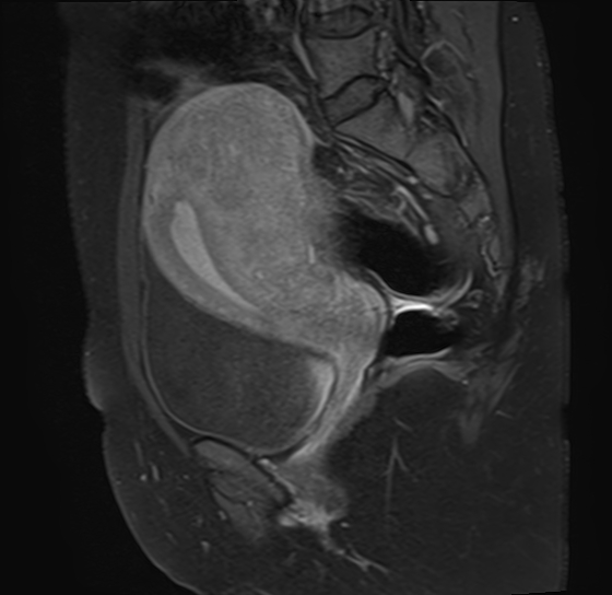 File:Adenomyosis - ovarian endometriomas (Radiopaedia 67031-76350 Sagittal T1 C+ fat sat 15).jpg