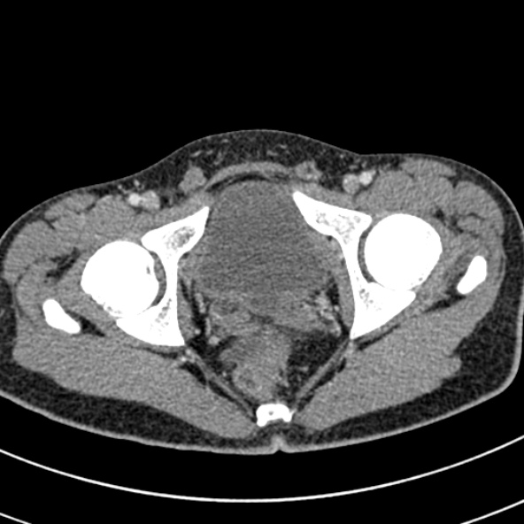 Adhesional small bowel obstruction (Radiopaedia 52107-57980 Axial C+ portal venous phase 122).jpg