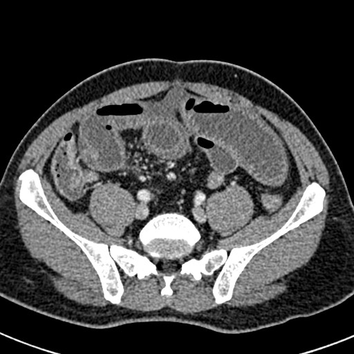 File:Adhesional small bowel obstruction (Radiopaedia 58900-66131 Axial C+ portal venous phase 38).jpg