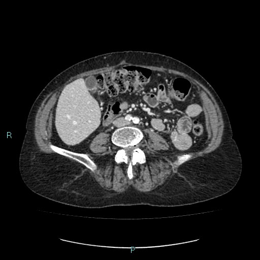 File:Adrenal collision tumor (ACT) (Radiopaedia 48462-53379 Axial C+ portal venous phase 34).jpg