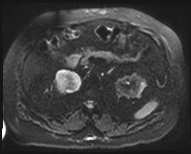 Adrenal cortical carcinoma (Radiopaedia 64017-72770 Axial DWI 62).jpg