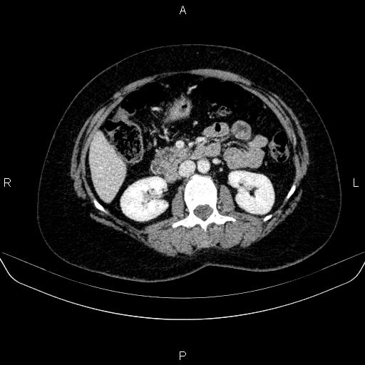 Adrenal cortical carcinoma (Radiopaedia 84882-100379 Axial C+ portal venous phase 39).jpg