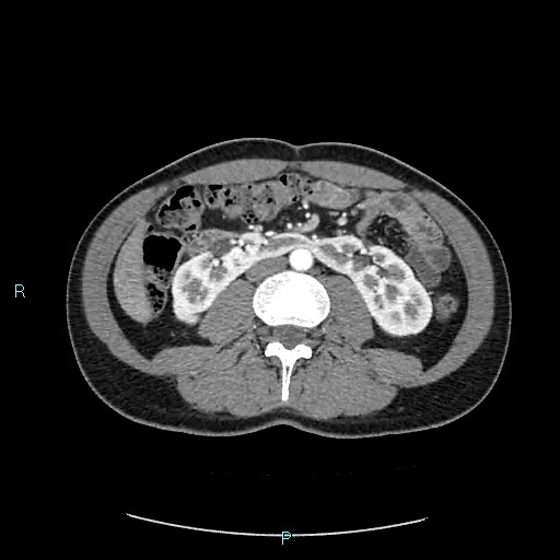 Adrenal cystic lymphangioma (Radiopaedia 83161-97534 Axial C+ arterial phase 49).jpg