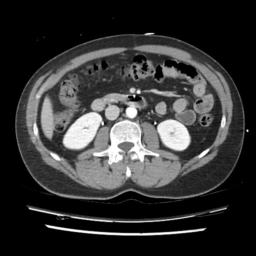 Adrenal gland trauma (Radiopaedia 81351-95078 Axial Dual bolus trauma C+ 76).jpg