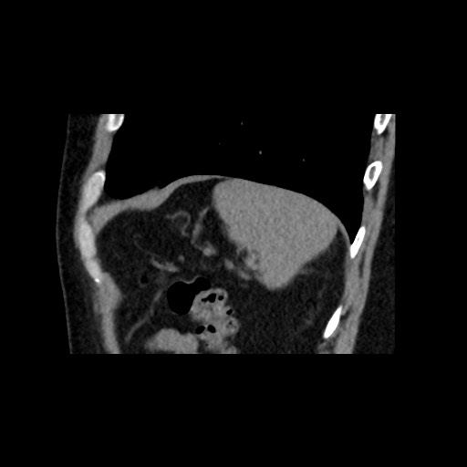 Adrenal gland trauma (Radiopaedia 81351-95079 Sagittal non-contrast 85).jpg