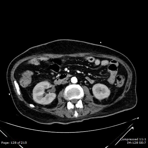 Adrenal metastasis (Radiopaedia 78425-91079 Axial C+ arterial phase 58).jpg