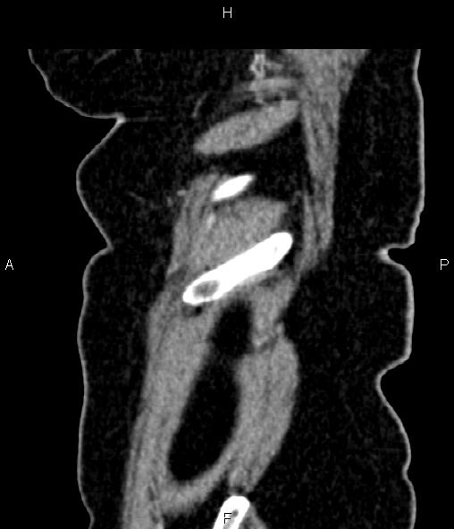 Adrenal myelolipoma (Radiopaedia 82742-96986 Sagittal renal cortical phase 100).jpg