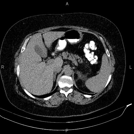 File:Adrenal myelolipoma (Radiopaedia 84319-99617 Axial With oral contrast 60).jpg