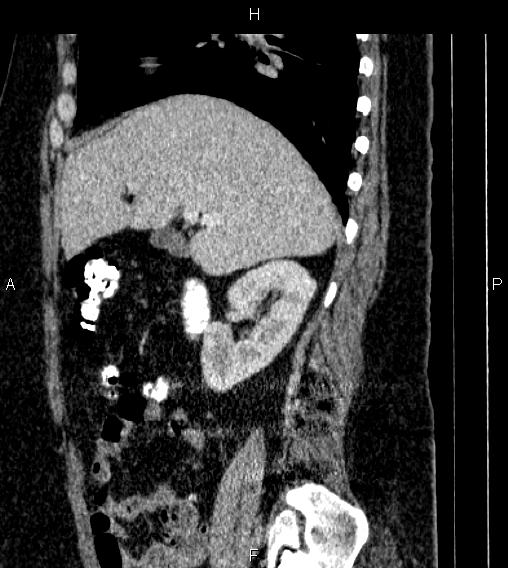 Adrenal myelolipoma (Radiopaedia 84319-99617 Sagittal renal cortical phase 30).jpg