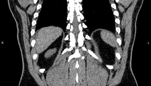 File:Adrenal myelolipoma (Radiopaedia 84321-99619 Coronal non-contrast 66).jpg