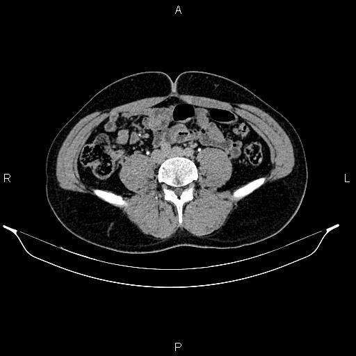 Adrenal myelolipoma (Radiopaedia 87794-104246 Axial renal excretory phase 64).jpg