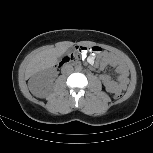Adrenal myelolipoma - bilateral (Radiopaedia 74805-85810 Axial non-contrast 39).jpg