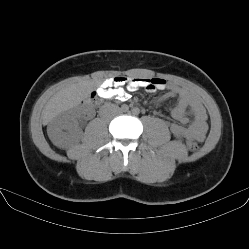 Adrenal myelolipoma - bilateral (Radiopaedia 74805-85810 Axial non-contrast 43).jpg