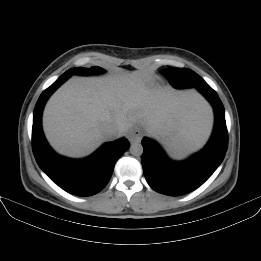 Adrenal myelolipoma - bilateral (Radiopaedia 74805-85810 Axial non-contrast 8).jpg