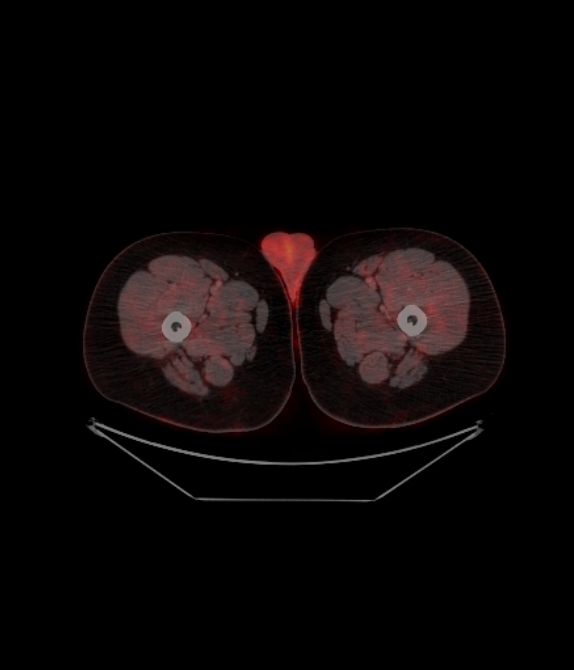 Adrenocortical carcinoma (Radiopaedia 80134-93440 ِAxial 288).jpg
