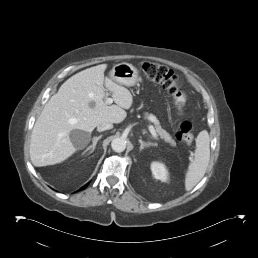 Adult ileal intussusception with secondary obstruction (Radiopaedia 30395-31051 Axial C+ portal venous phase 18).jpg