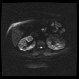 Adult polycystic kidney disease (Radiopaedia 59075-66365 Axial DWI 51).jpg