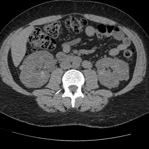 Adult polycystic kidney disease (Radiopaedia 59075-66368 Axial non-contrast 43).jpg