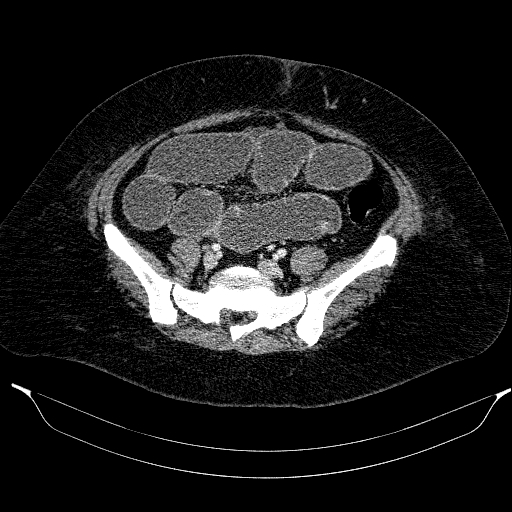 Afferent loop syndrome - secondary to incarcerated trocar site hernia (Radiopaedia 82959-97305 Axial C+ portal venous phase 170).jpg