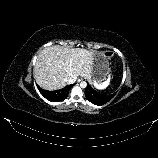 Afferent loop syndrome - secondary to incarcerated trocar site hernia (Radiopaedia 82959-97305 Axial C+ portal venous phase 34).jpg