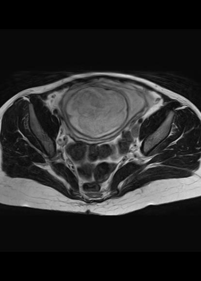 File:Aggressive angiomyxoma of the pelvis and perineum (Radiopaedia 59162-66479 Axial T2 15).jpg