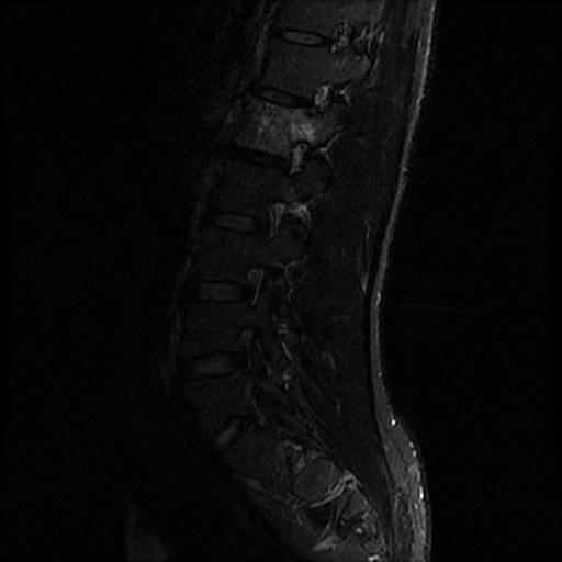 File:Aggressive vertebral hemangioma with pathological fracture (Radiopaedia 69528-79411 Sagittal STIR 8).jpg