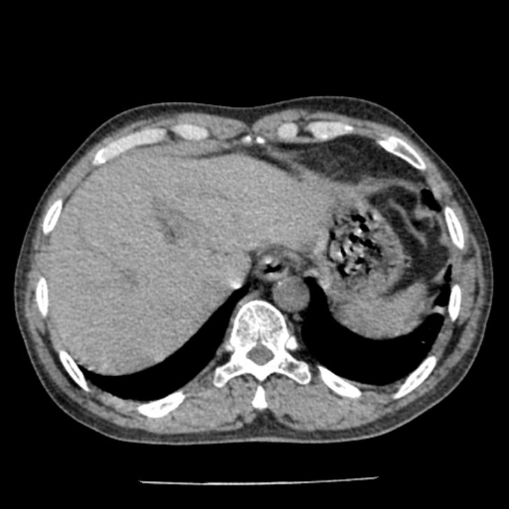 Airway foreign body in adult (Radiopaedia 85907-101779 Axial liver window 175).jpg