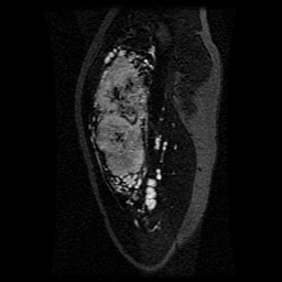 Alveolar soft part sarcoma (Radiopaedia 64501-73678 D 101).jpg