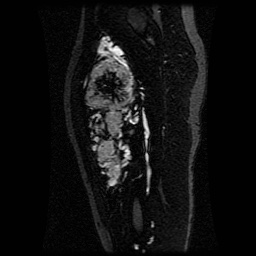 Alveolar soft part sarcoma (Radiopaedia 64501-73678 D 73).jpg