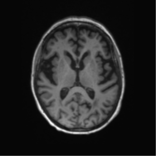 Alzheimer's disease (Radiopaedia 42658-45802 Axial T1 77).png